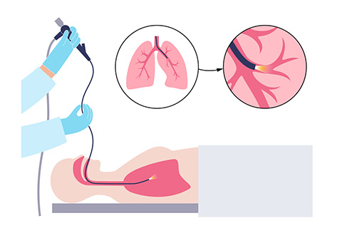 Bronchoscopy Specialist Redwood City CA