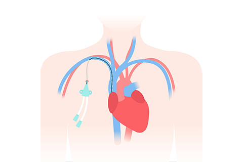 Right Heart Catheterization Specialist Redwood City CA