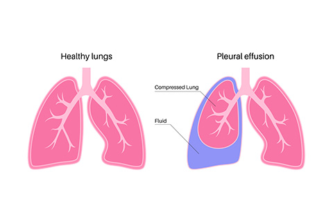 Healthy vs Compressed Lung
