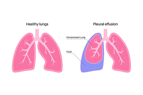 Thoracentesis Specialist Redwood City CA