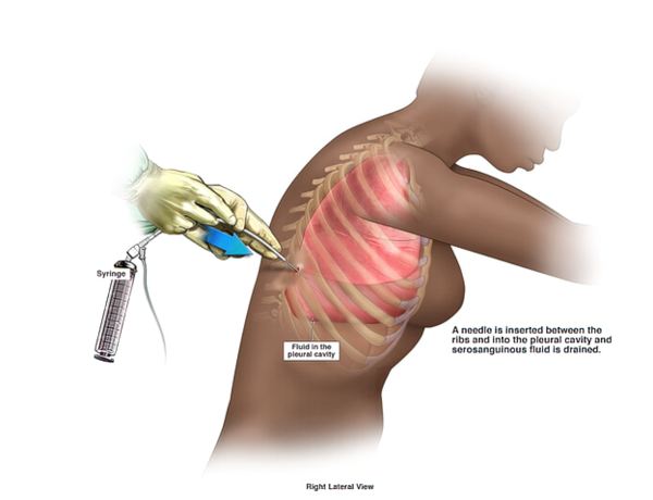 Thoracentesis